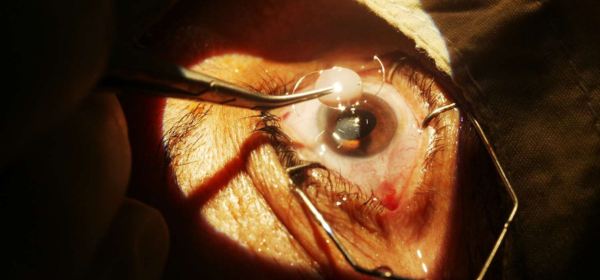 Cataract Surgery