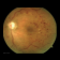Diabetic Retinopathy